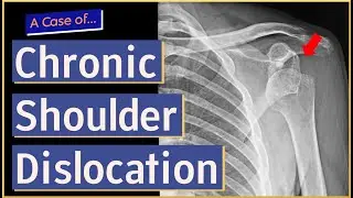 Chronic Shoulder Dislocation
