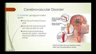 Neuroplastisitas dan kerusakan otak