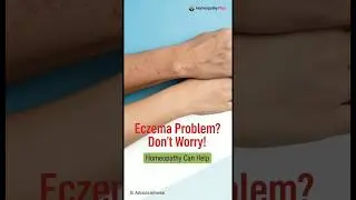 How to Treat Eczema Naturally | Best Homeopathic Medicines  | #homeopathy#shorts #shortsfeed