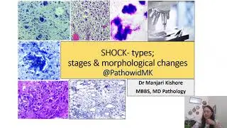 Shock- Types, Stages & Morphological changes