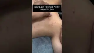 Shoulder trigger point Dry NEEDLING 💫✅