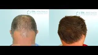 2979 Grafts FUE Hair Transplant Dr. Michalis