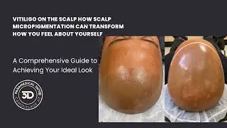 Vitiligo on the Scalp How Scalp Micropigmentation Can Transform How You Feel About Yourself