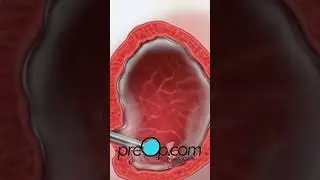 PreOp&reg; 💕 TURBT in Females: Key Facts #preop #patienteducation #health  #shorts 🧪