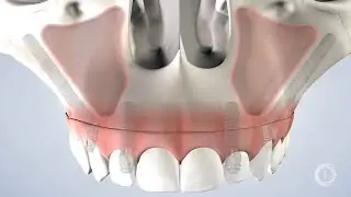 Zygomatic Implants at Innovative Oral Surgery & Dental Implants