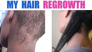Hair Regrowth | Coconut Oil or Shea Butter Mixture