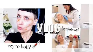 ☕️VLOG💉M&Oacute;J PIERWSZY ZABIEG MEDYCYNY ESTETYCZNEJ●GOJENIE●PIELĘGNACJA●CZY WARTO?●5 DNI PO ZABIEGU
