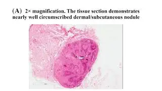 2020 OAP AGM Abstract - Piolmatrixoma with Atypical Features Dr. Manal Gabril