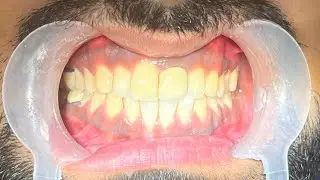 Scaling And Polishing Procedure