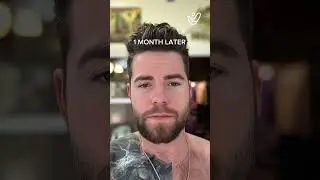 I Flew to Turkey for a LIFE CHANGING Beard Transplant!