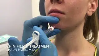 Chin augmentation with filler (Restylane Lyft) by Dr. Shaun Patel