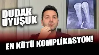 Mandibular Kanala Yabancı Cisim Kaçarsa Ne Olur? Dudakta Uyuşukluk, Kanal Tedavisi Dolgusu