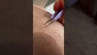INGROWN Hairs are the Devil 😈 #sugarwax #shorts