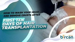 HOW TO WASH YOUR HEAD AND REMOVE CRUSTS AFTER THE FIRST TEN DAYS OF HAIR TRANSPLANTATION