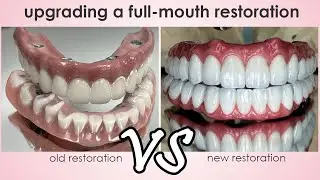 Replacing a Screw-Retained Restoration with a Futuristic Full-Mouth Solution