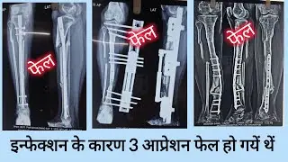 Tibia bone fracture infection and Non-union treatment with Ilizarov Surgery #ilizarovsurgery