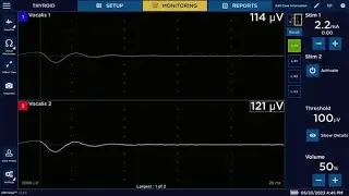 NIM Vital&trade; nerve monitoring system Set-up -  Quick Tags