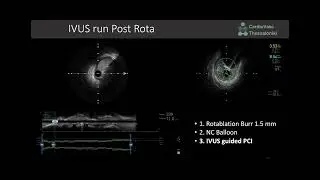 FFR-Based Decision Making and IVUS-Guided Rotational Atherectomy in Complex Multivessel PCI