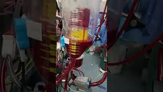 The human blood outside the body. Heart and lung machine. Open heart surgery. #heart