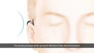 Cochlear&trade; Baha&reg; Attract System - How it Works