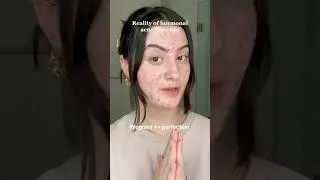 The truth about having hormonal acne 💔🥹 #realskintexture #acnejourney #skinpositivity