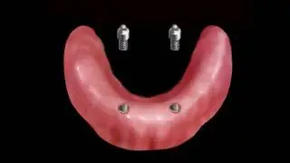 Proteza overdenture na 2 implantach