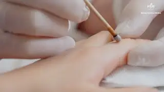 Usuwanie brodawek za pomocą patyczk&oacute;w z azotanem srebra SILVERIN