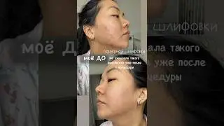 Лазерная шлифовка лица: как заживала моя кожа по дням #лазернаяшлифовка #лайфстайлблог #заботаосебе