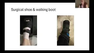 Physio2U Team Inservice on Lapiplasty for bunions by Kristen Duncan, Registered Physiotherapist