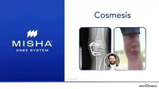 MISHA Knee System Appearance - Patient and Surgeon Perspectives