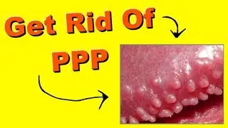How to remove pearly penile papules at home fast and easy