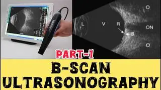 Ультрасонография B-сканирования #bscan #глаз #оптометрия #офтальмология #youtube #тренды #optocru...