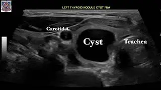 Thyroid cystic nodule treatment by Sean Nikravan, MD, FACE. Thyroid Institute.