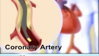 Angioplasty