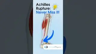 Achilles Rupture: How To Never Miss It!! #physiotherapy #achilles #physicaltherapy