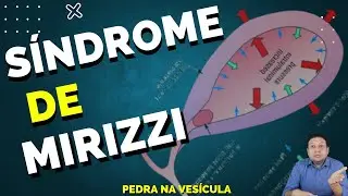 PEDRA NA VESÍCULA - SÍNDROME DE MIRIZZI UMA COMPLICAÇÃO DA PEDRA NA VESÍCULA.