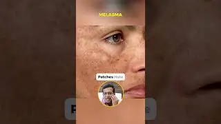 Face पर Brown Spots क्यों होते हैं? | Pigmentation vs Freckles vs Melasma | Kya Hai Asli Difference?