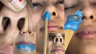 Nose hair waxing and lower lips waxing by Hard wax beans/ #nosehairwaxing #brazillianwax #hardwax 