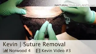 Hair Transplant Suture Removal | Hair Transplant Scar (Kevin)