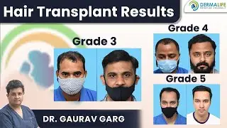 Hair Transplant Results in Multiple Grades of Baldness | Grade 3, Grade 4, Grade 5 | South Delhi