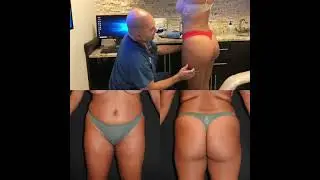 Liposuction & BBL results after 3 months - Makeover by Doctor Mendieta
