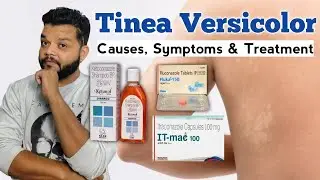 Tinea Versicolor लक्षण, कारण और इलाज | Fungal Infection Treatment 