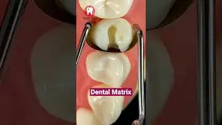 Dental Matrix #shorts