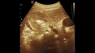 15 years Girl Increase Cortical Echogenicity Right Kidney