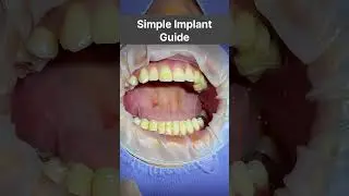 좁은 공간 임플란트 수술가이드 #dental #dentist #implantguide