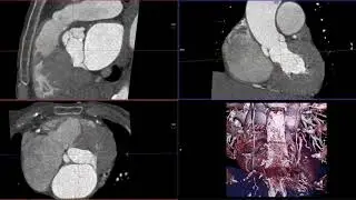 Measurement of membranous interventricular septum length in cardiac CT prior to TAVI