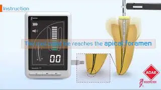 ADAE woodpecker III pro apex locator