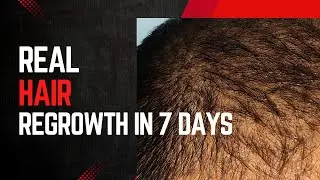 Real hair regrowth in 7 days #captureride #hairregrowth #jamalgota #haircare #hair #hairgrowth