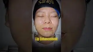 Surgical & Non Surgical Full Face Sculpting | By Dr  Adarsh Tripathi - Sarayu Clinics, New Delhi