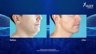 What is Vaser Liposuction?